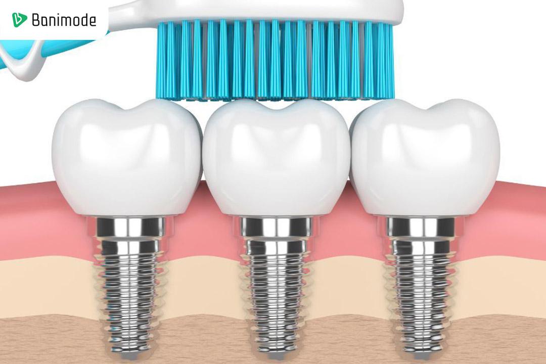 بهترین مسواک برای ایمپلنت | معرفی 5 مدل مسواک مناسب ایمپلنت