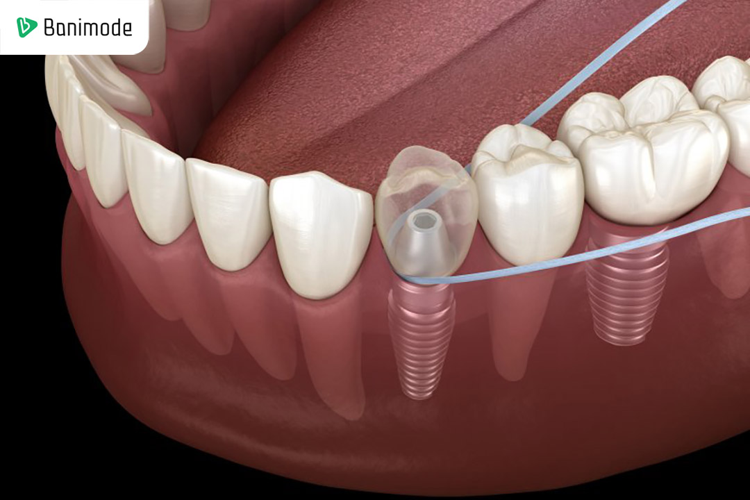 مسواک بین دندانی و نخ دندان مخصوص ایمپلنت